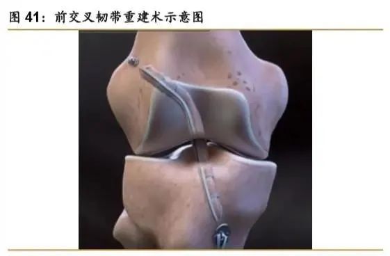 开云体育 开云平台骨科疾病市场产品大盘点 医疗器械综述系列(图26)