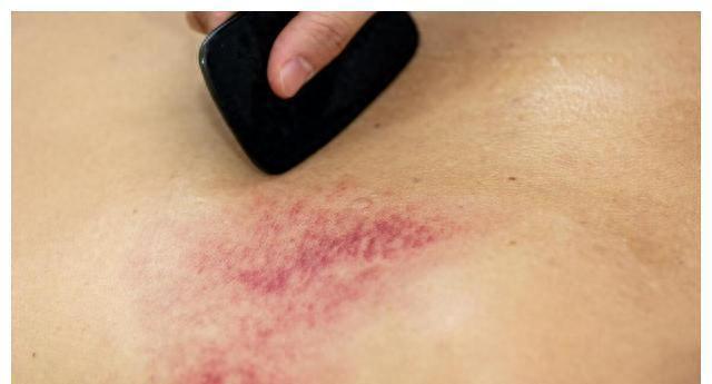 开云 开云体育平台杭州亚运搞笑一幕：伊朗球员背上拔罐印记清晰网友你是来大保健(图4)