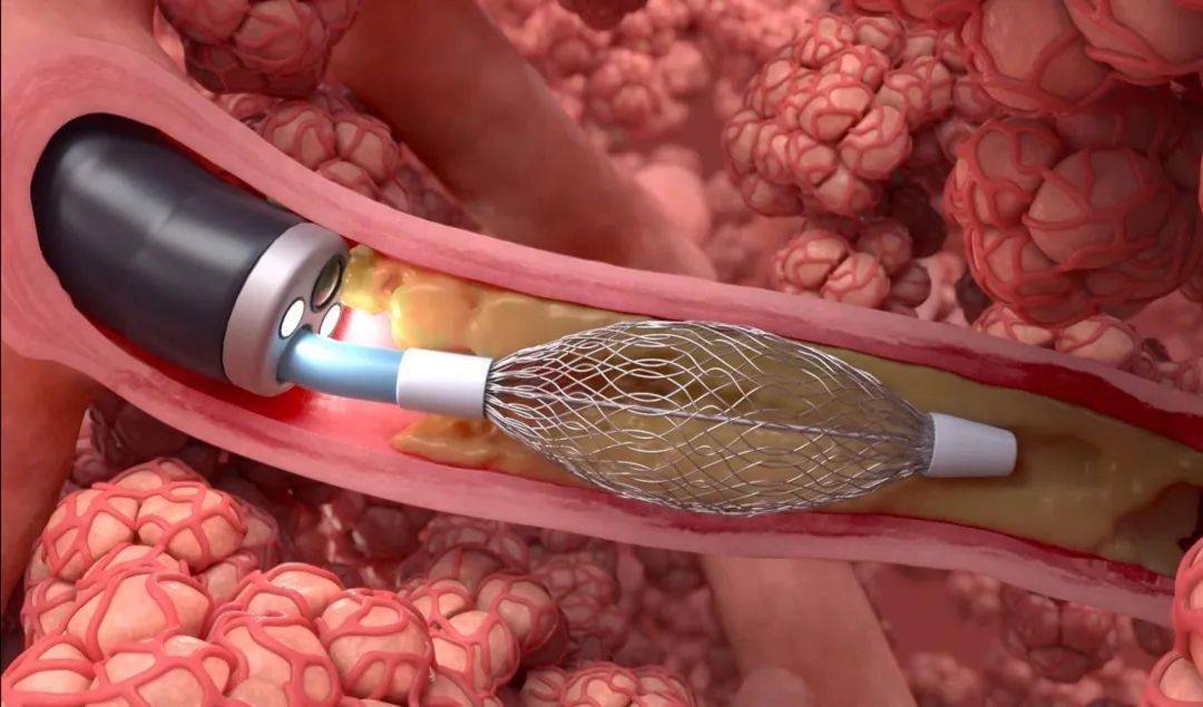 医疗器械行业分析：万亿开云体育 开云官网市场这些赛道潜力无限不容错过！(图22)