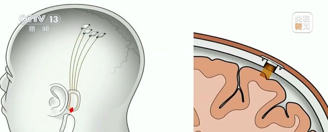 治疗帕金森、提高专注力脑机接口安全吗？能